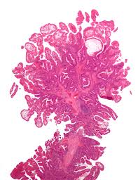 doença de Crohn