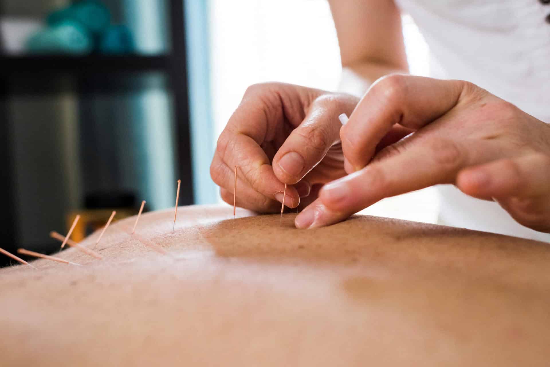 acupuntura para idosos